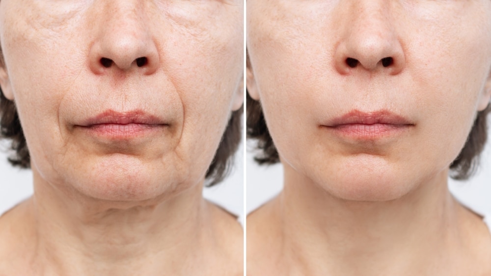 tretmani za pomlađivanje lica